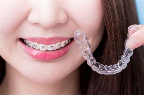 Invisalign Vs Braces Cost North Sydney Dentistry