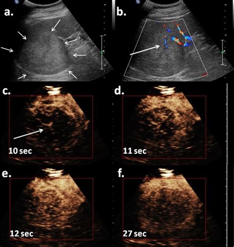 A Gray Scale Ultrasound Showed A Mildly Hyperechoic Mass In The