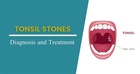 Tonsil Stones Signs Causes Symptoms And Its Treatment Adventis