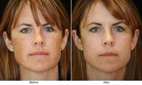 Bbl Photofacial Reduce Signs Of Aging And Skin Imperfections