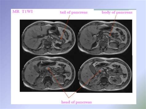 Congenital Anomalies Of Pancreas And Hepatobiliary System Radiology Ppt