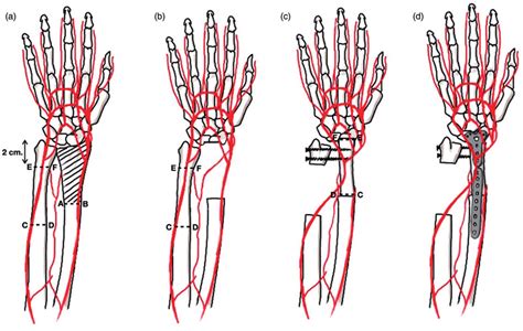 A Osteotomy Locations In The Radius Ab And Ulna Cd Ef The