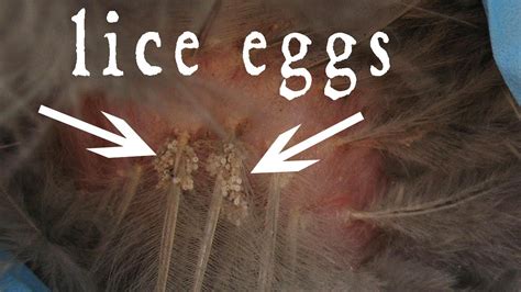 How To Remove Dead Lice Eggs From Hair Youtube