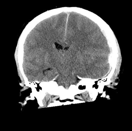 Posterior Cerebral Artery Territory Infarct Due To Subdural Hematoma