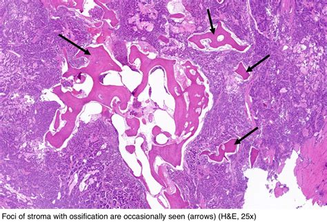 Pathology Outlines Typical Carcinoid