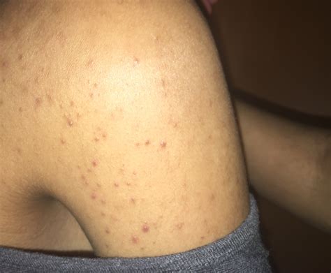 Pesky Acne On Shoulders Halp Backbodyneck Acne Community