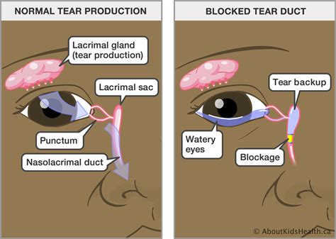 Blocked Tear Ducts