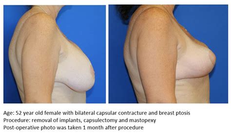 Mastopexy Breast Lift UF Health Plastic Surgery And Aesthetics