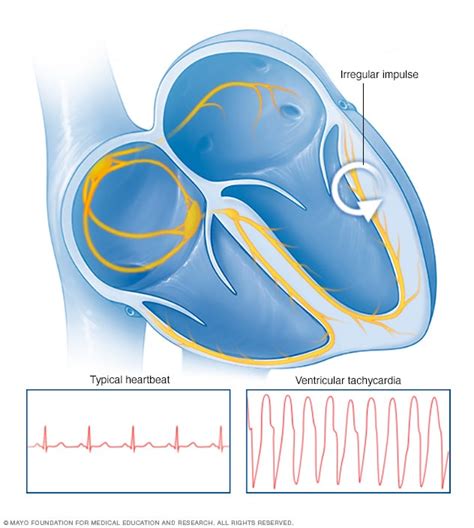 Heart Arrhythmia Symptoms And Causes Mayo Clinic