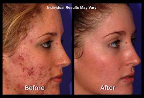 How Much Is Laser Treatment For Acne