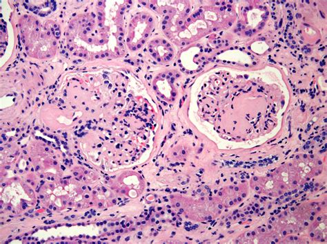 Pathology Outlines Nonneoplastic Kidney