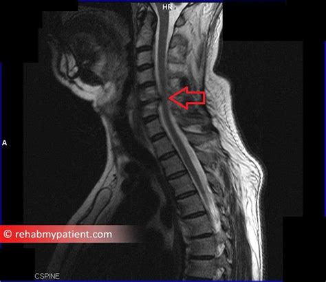 Pinched Nerve In Neck X Ray