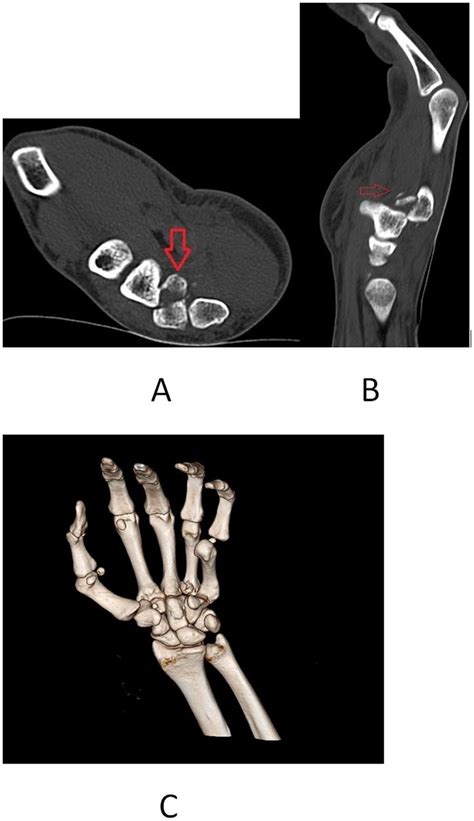 A Axial Ct Shows Fracture Of 4th Metacarpal Base Thick Red Arrow B