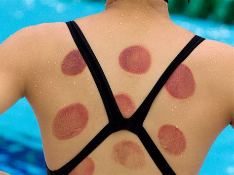 Cupping Is The New Thing Olympic Swimmers Go Holistic