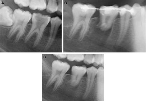 Autotransplantation Of Third Molars With Platelet Rich Plasma For