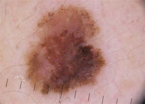 Superficial Spreading Melanoma With A Breslow Index Of Open I