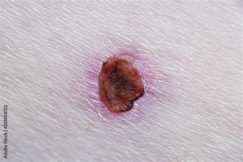 Healing Wound With Scab After Basal Cell Skin Cancer Laser Treatment