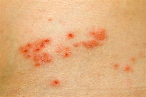 Shingles Pain 5 Myths And Facts To Set You Straight University