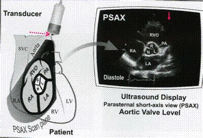 Echocardiography Flashcards Quizlet