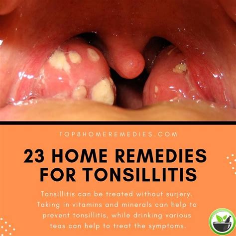 Home Remedies For Tonsillitis Tonsilitis Remedy Strep Throat