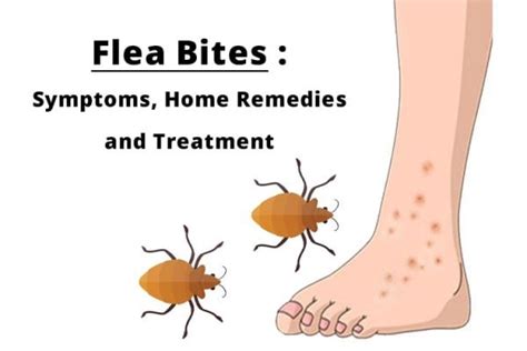 Flea Bites Symptoms Home Remedies And Treatment
