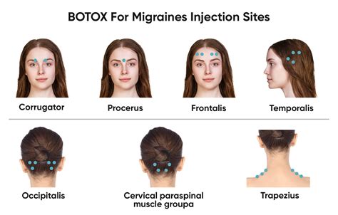Botox For Migraines Bellevue And Kirkland Best Botox Bellevue