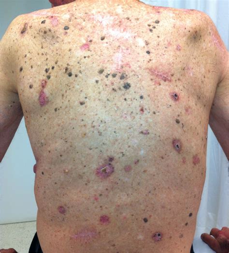 Squamous Cell Skin Cancer Photos