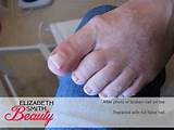 Split Thumb Nail Repair Images