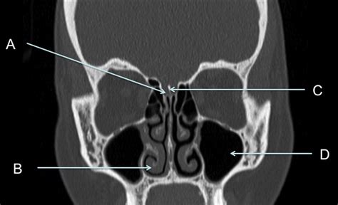 Coronal Computed Tomography Image Through The Face Bone Windows The Bmj