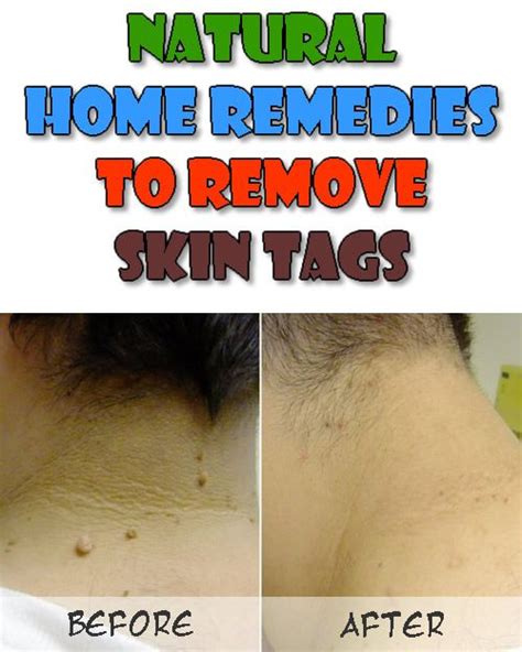 natural home remedies to remove skin tags skin tag removal skin tags home remedies skin tag