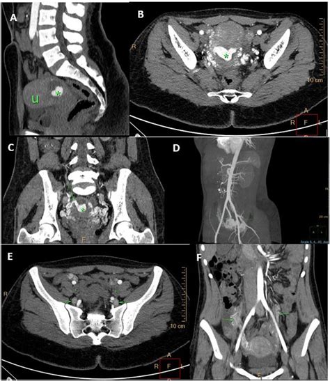 A B Sagittal And Axial Images Of A Cta Of Patient 1 Illustrating A
