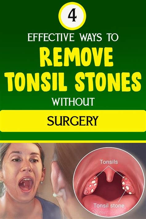 4 Effective Ways To Remove Tonsil Stones Without Surgery Healthy