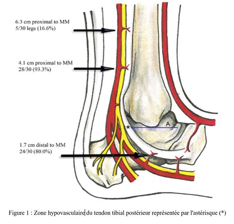 Tendinopathy Or Posterior Tibial Tendon Dysfunction A Condition Like