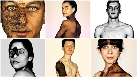 Photography Exhibition Featuring People With Rare Skin Condition Seeks