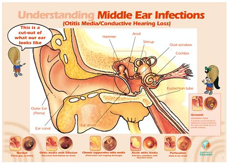 Md ☞ Middle Ear Infections
