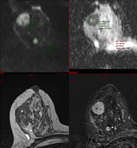 Multiparametric Breast Mri From Top Left To Bottom Right Dwi B850