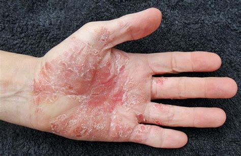 Psoriasis Cream Skin Moss Removal Cream Pityriasis Versicolor Sweat
