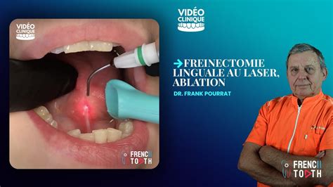 Freinectomie Linguale Au Laser Ablation Dr Pourrat YouTube