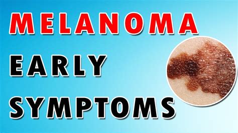 Melanoma Skin Cancer Symptoms Prognosis And Treatment Dermatology Course 3160 Youtube