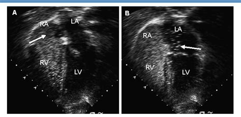 Figure 1 From Patent Foramen Ovale In Children With Migraine Headaches