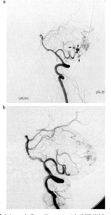 Figure From Endovascular Treatment Of Cerebral Aneurysms Associated