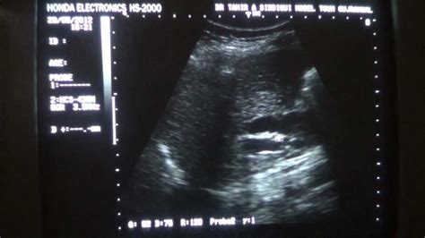 Ultrasound Dilated Common Bile Duct Youtube