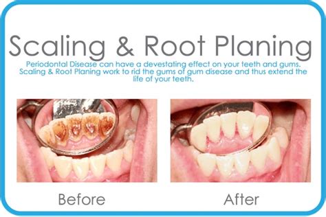 Dentist In State College Scaling And Root Planing In State College