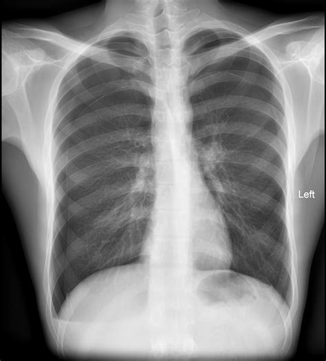 Pneumothorax develops when air enters the pleural space as the result of disease or injury. Pnuemothorax / Pneumothorax Pediatric Radiology Case ...