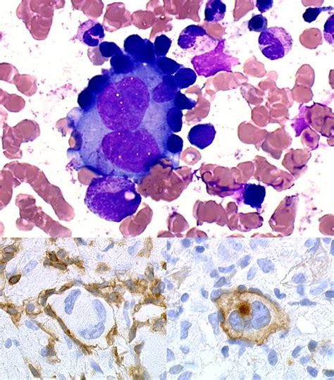 Reed Sternberg Celllymphocyte Rosettes In A Bone Marrow Aspirate