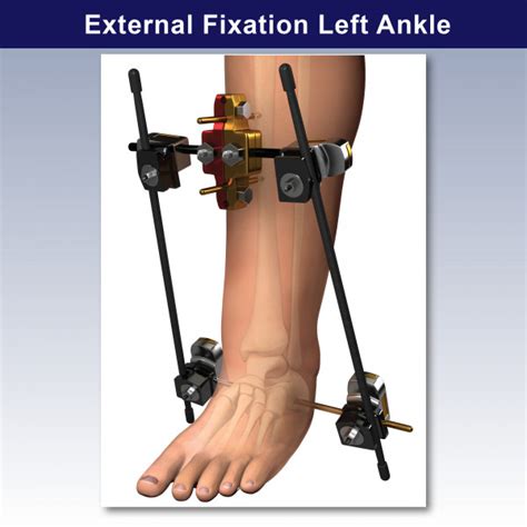 If temporary external fixation is planned, a ct scan done following application of the external fixator and realignment of the limb provides the best information. External Fixation Left Ankle - TrialExhibits Inc.