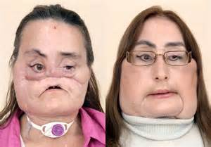 Face Transplant Recipient Connie Culp Abc News Australian