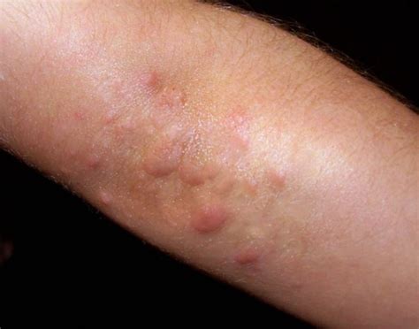 Itchy Elbows Causes Bumps Rash No Rash Non Itchy Symptoms Treat Home Remedies