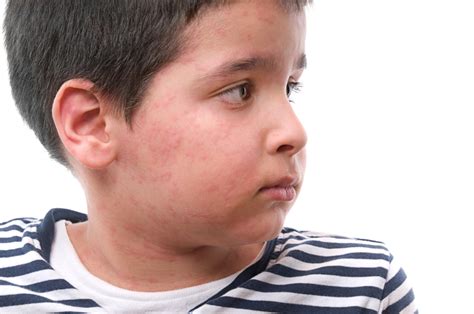 Green Hills Pediatric Associates Common Rashes In Children