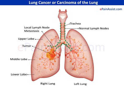 People who smoke have the greatest risk of lung cancer, though lung cancer can also occur in people who have never smoked. Lung Cancer: Treatment, Causes, Symptoms, Risk Factors, Stages